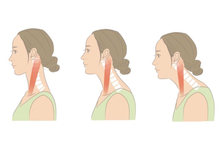 ストレートネックのイメージ図